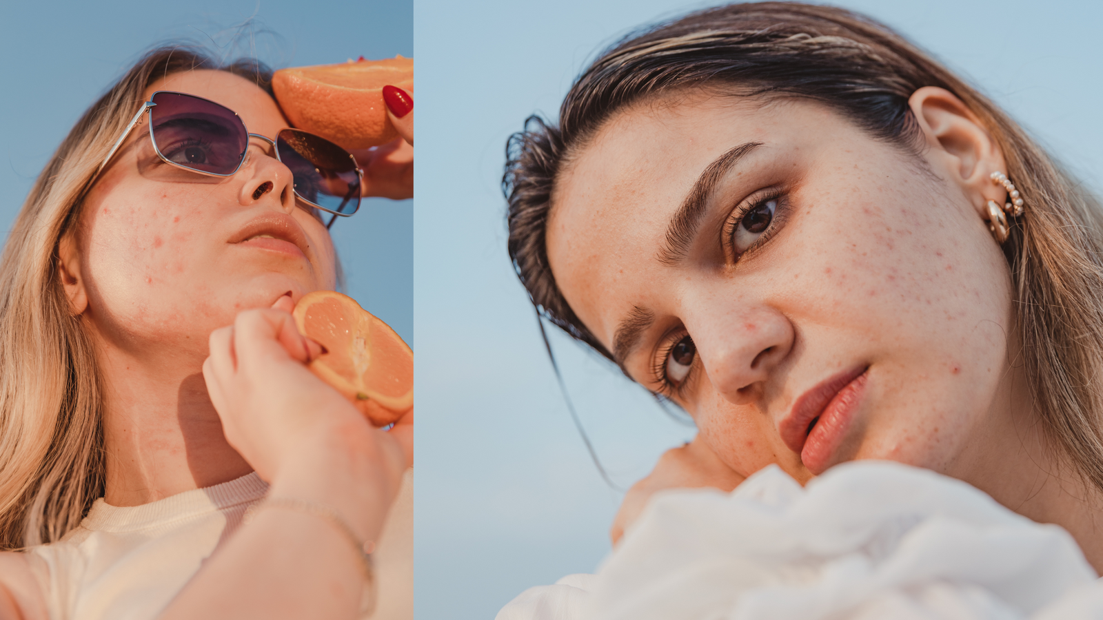 Close-up of a woman touching her cheek with clear skin, illustrating how hormonal imbalances involving estrogen, progesterone, and cortisol cause hormonal acne